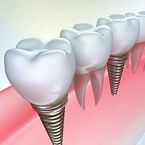 Несъемное протезирование зубов