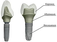 Имплантация зубов: коронка, абатмент, имплант