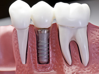 Протезирование зубов методом имплантации