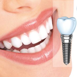 Зубной имплантат