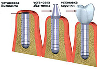 Порядок протезирования зубов при имплантации