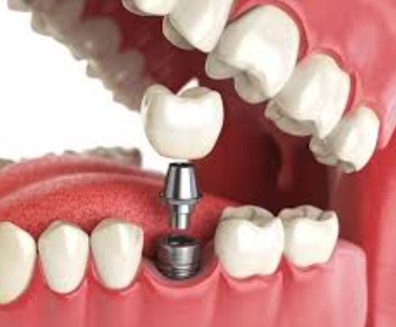 Дента-Практик - стоматология в свиблово недорого делает имплантацию зубов.