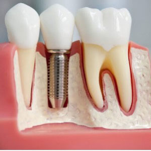 Имплантация зубов в Свиблово