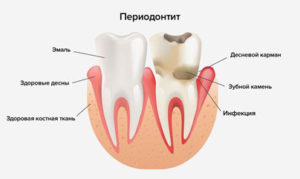 Лечение периодонтита Бабушкинская