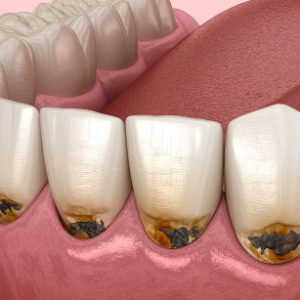 Лечение зубов. Бабушкинская. Недорого в Дента-Практик.