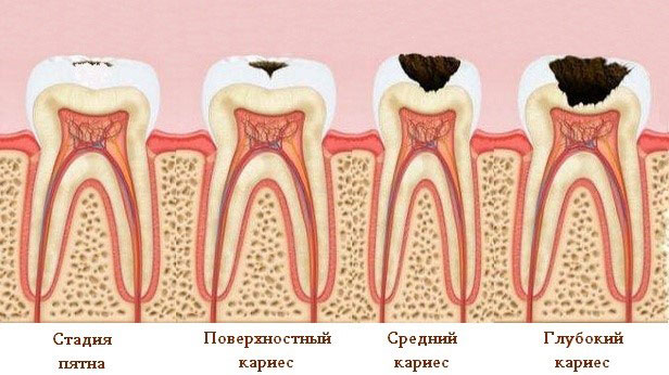 Лечение кариеса недорого в Москве