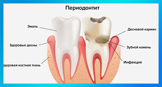 Лечение периодонтита