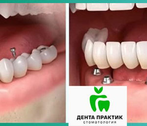 Имплантация зубов. Цена дешевле чем во многих клиниках в Москве.