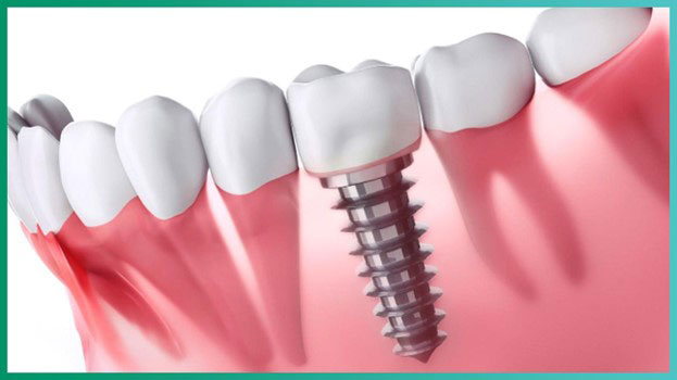 Имплантация зубов. Цена в стоматологии
