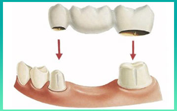 Альтернатива имплантации зубов в стоматологии 