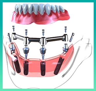 Полный съемный протез на 4 имплантах 