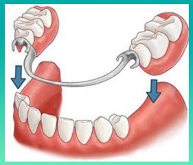 Съемные протезы