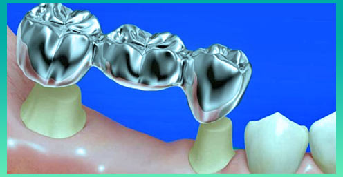 Восстановление зуба металлокерамической коронкой