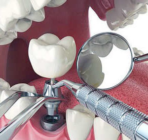 Этапы имплантации зубов.